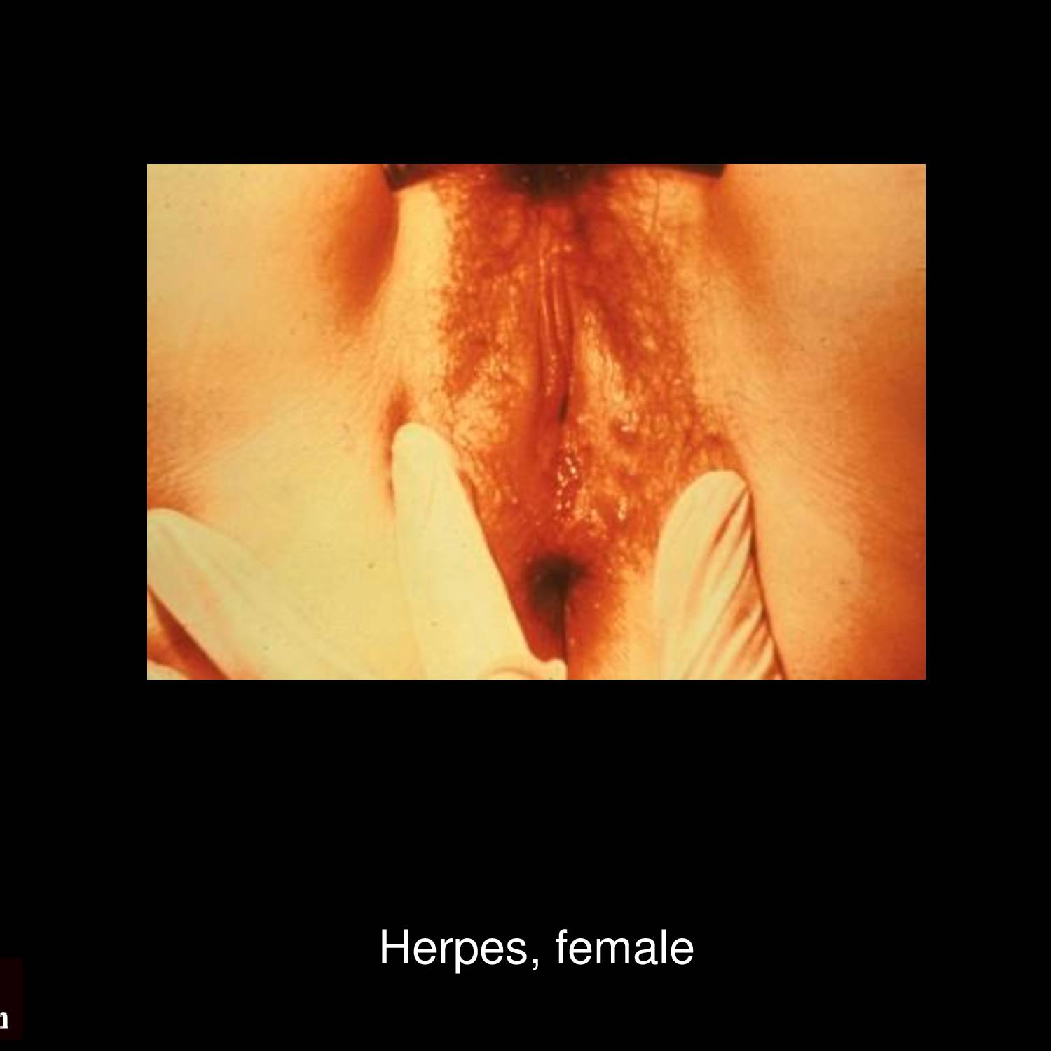 Extensive genital herpes outbreak with multiple vesicular lesions and erosions on male external genitalia caused by herpes simplex virus reactivation
